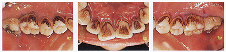 喫煙と歯周病